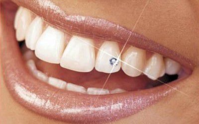 Nouveau pose de bijoux dentaire strass Swarovski